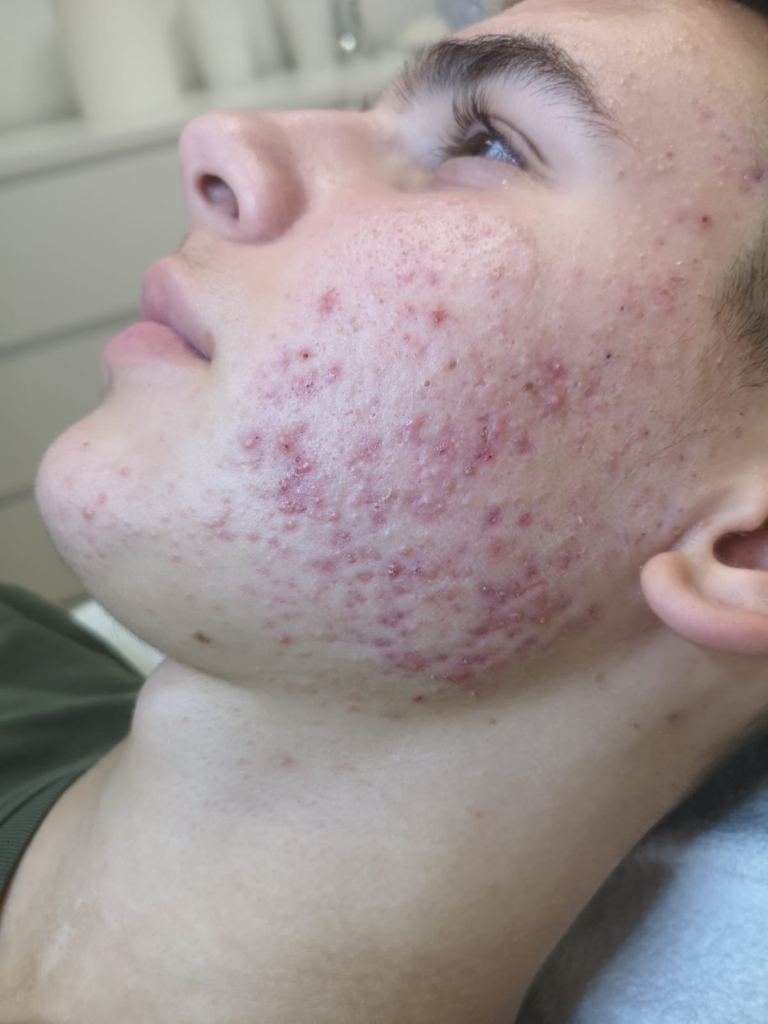 BioRePeelC13 voor: rechterzijde ernstige acne