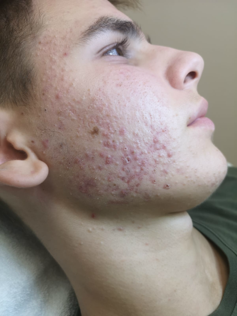 BioRePeelC13 voor: linkerzijde ernstige acne