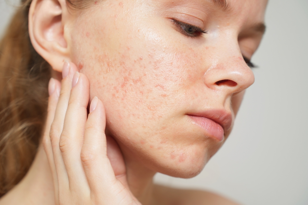 Acne behandeling bij Younique Skincare