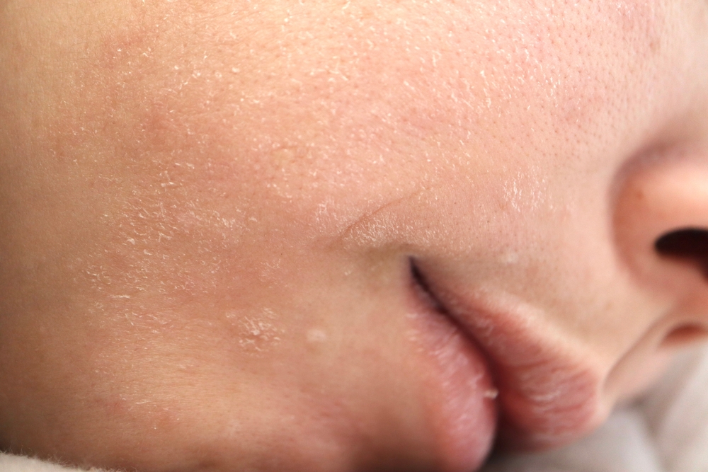 Droge huid behandeling bij Younique Skincare