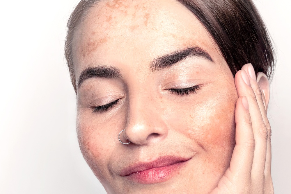 Pigmentvlekken behandeling bij Younique Skincare