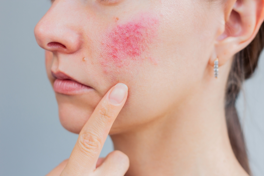 Rosacea en couperose behandeling bij Younique Skincare
