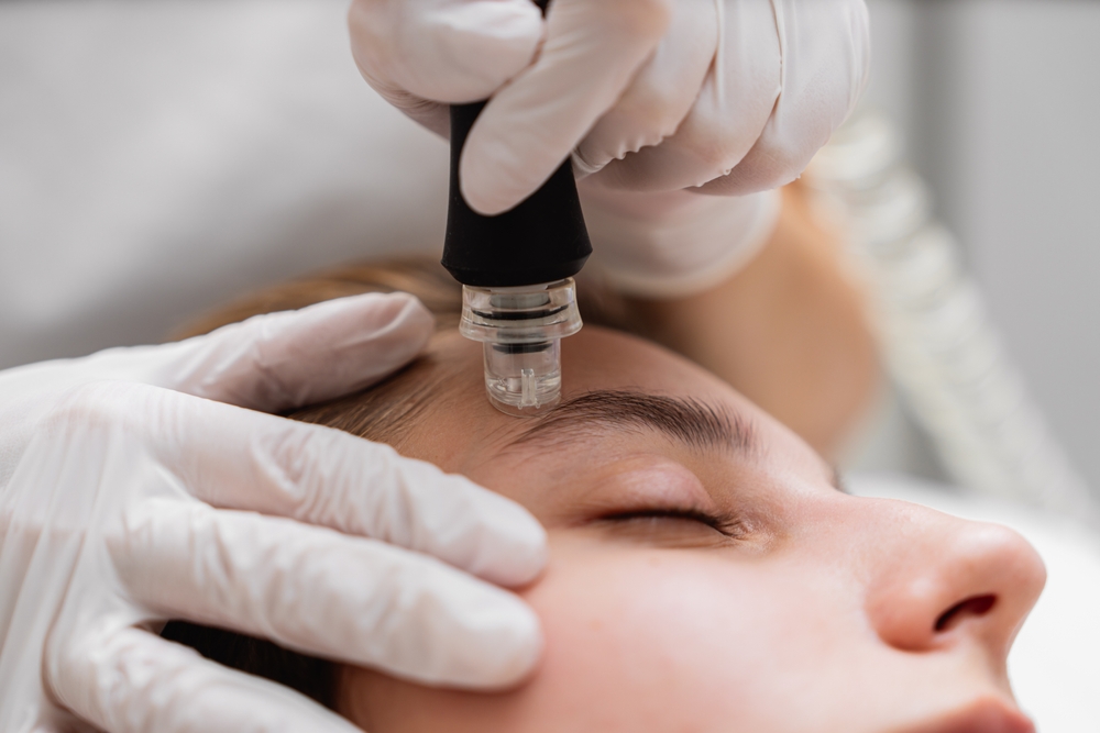 Microdermabrasie
