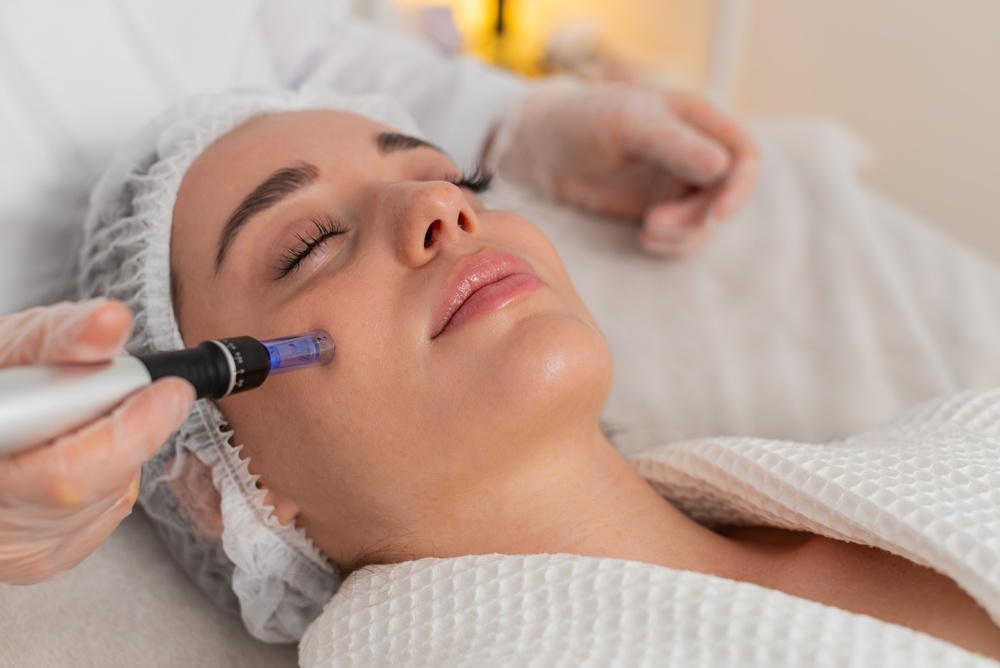 Microneedling behandeling