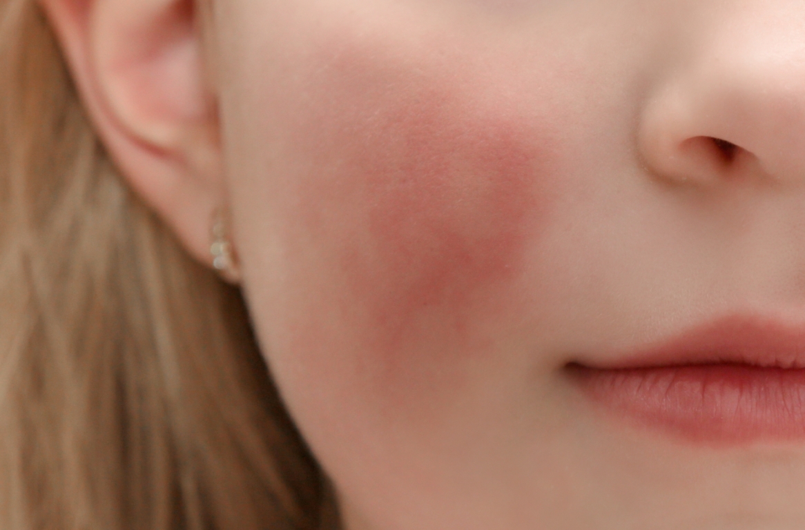 Rosacea behandeling behandeling bij Younique Skincare