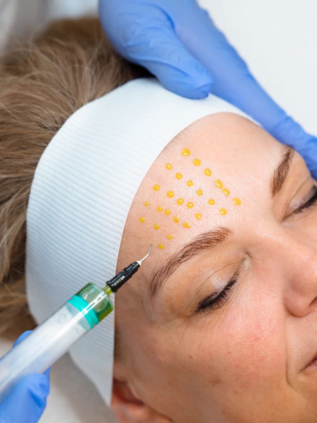 BioRePeelC13 peeling behandeling
