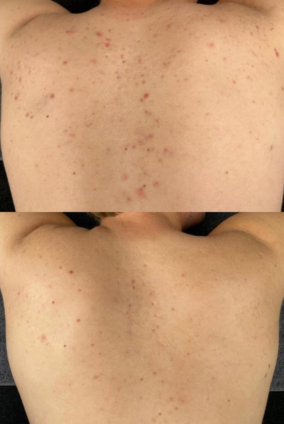 Voor en na Biopeel (rug)