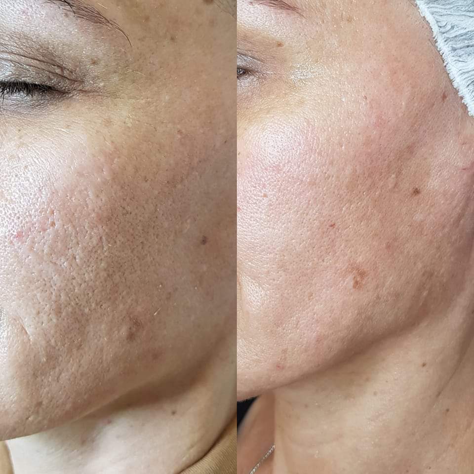 Littekens behandeling bij Younique Skincare