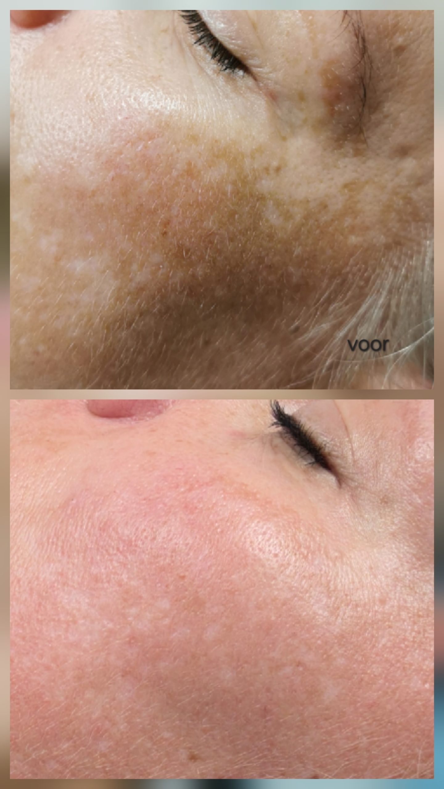 Real Peel fruitzuurpeeling bij Younique Skincare